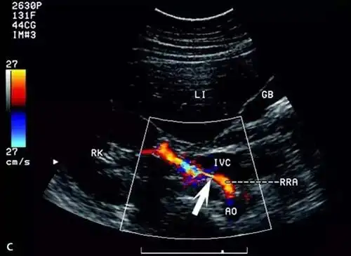 最简单的诊断办法是进行多普勒超声检查,彩超省时,无创,经济,可初步