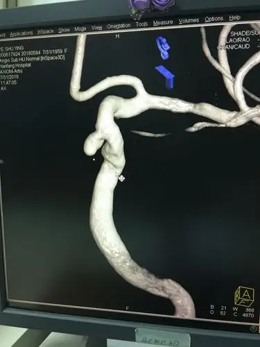 近期做的几台动脉瘤破裂出血就诊,介入栓塞的病例! - 好大夫在线