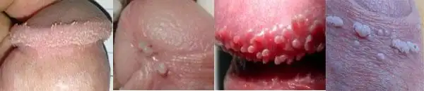 【尖锐湿疣典型症状】肉颗粒状 菜花状增生物