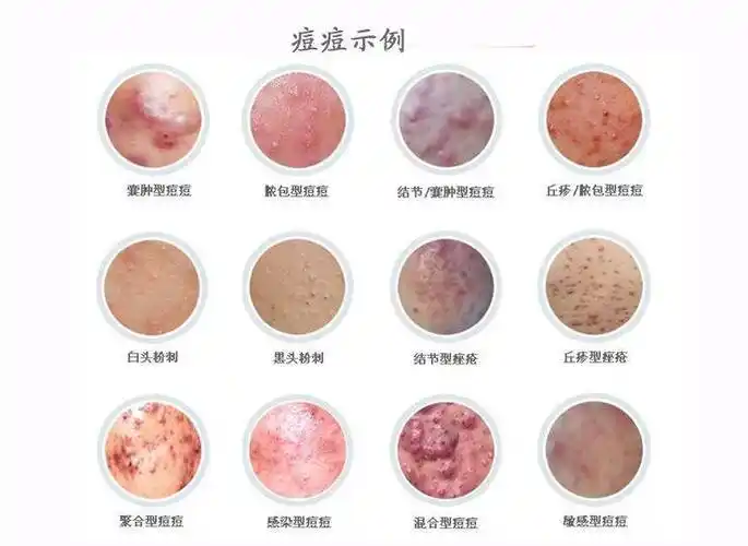 大家首先想到的必然是痘痘君痤疮的皮损主要分两类炎性丘疹和粉刺所谓