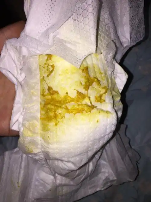 新生儿便便,11天的宝宝拉的,请问这是水样大便吗?是腹泻引起的吗