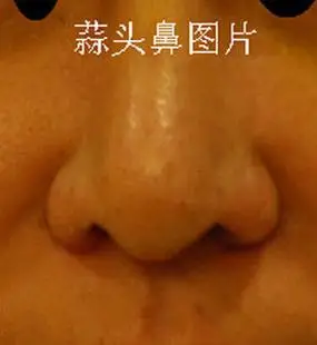 蒜头鼻鼻头肥大展示