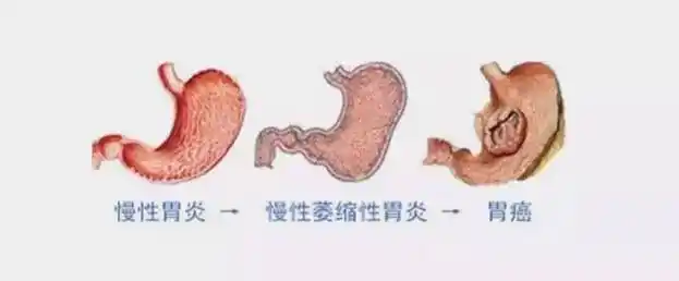 20161103我是大医生视频和笔记胃癌胃溃疡胃炎幽门螺杆菌