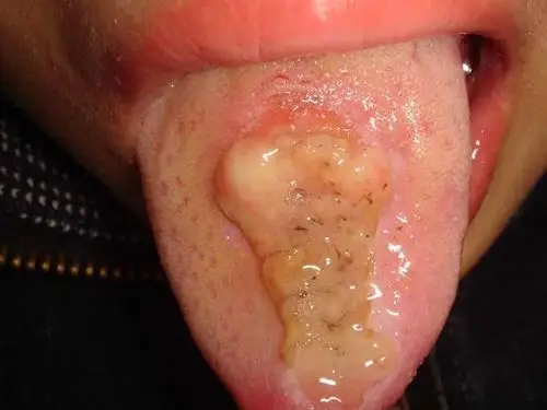 扁平苔藓(lichenplanus)是一种皮肤粘膜慢性炎症,可以单独发生于口腔