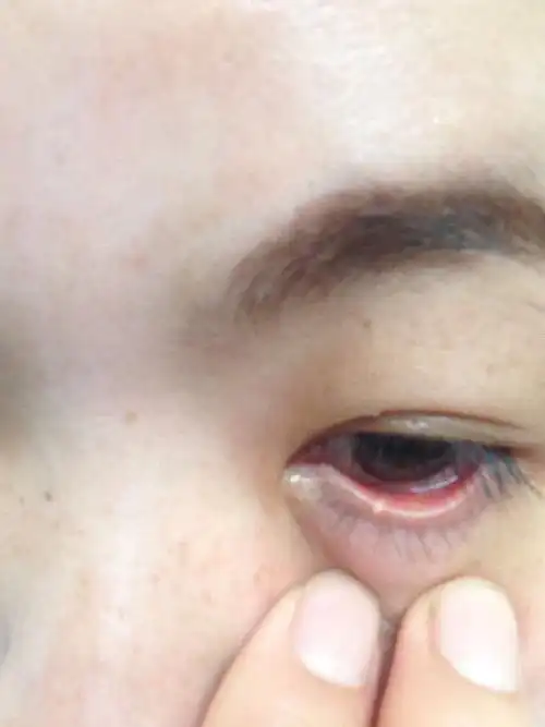 请问眼上的白点属于什么?有无大碍?