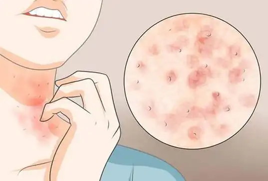 螨虫叮咬后的症状图教你几招彻底清除螨虫