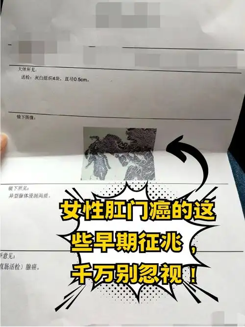 女性肛门癌的这些早期征兆,千万别忽视!