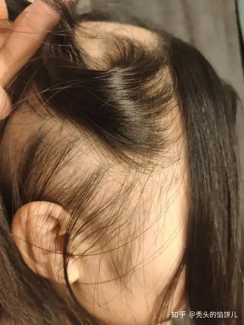 一个女生斑秃到全秃记录过程1,无广告,多图