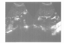 图1肝内胆管结石声像图