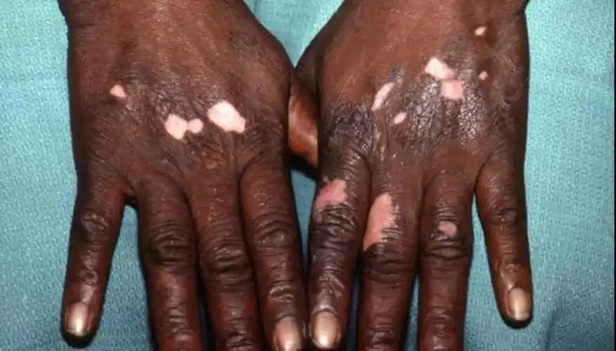 "除了以上常见的表现为 白斑 的皮肤病,还有很多,如斑驳病,白化病