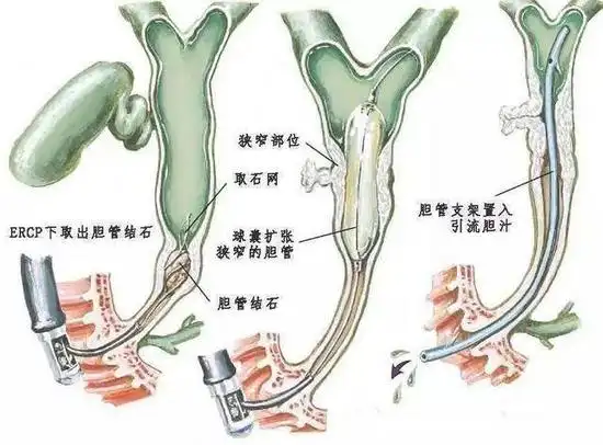 ercp行胆道取石术及胆管支架引流术示意图