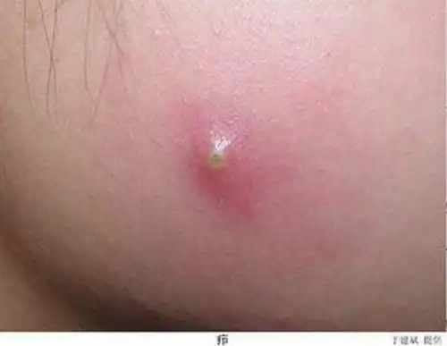 患有痈的症状是什么呢