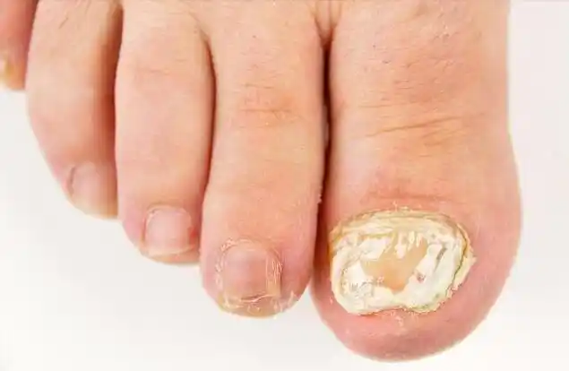 儿童灰指甲初期图片症状