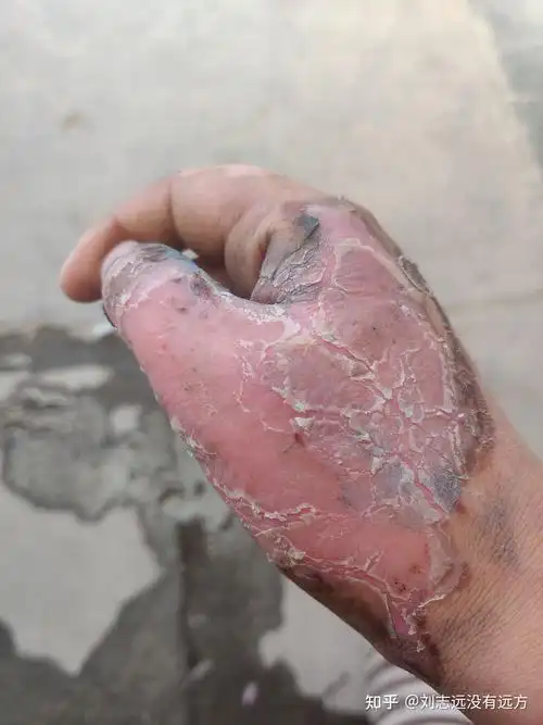 记录自己深二度烫伤第10天