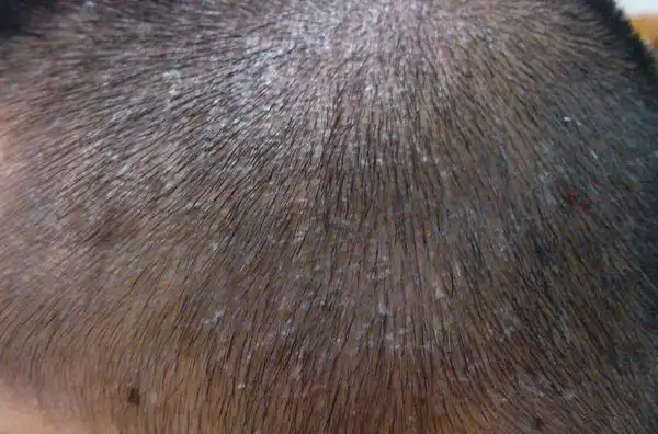 我头上有很多大块的头皮屑是什么问题?