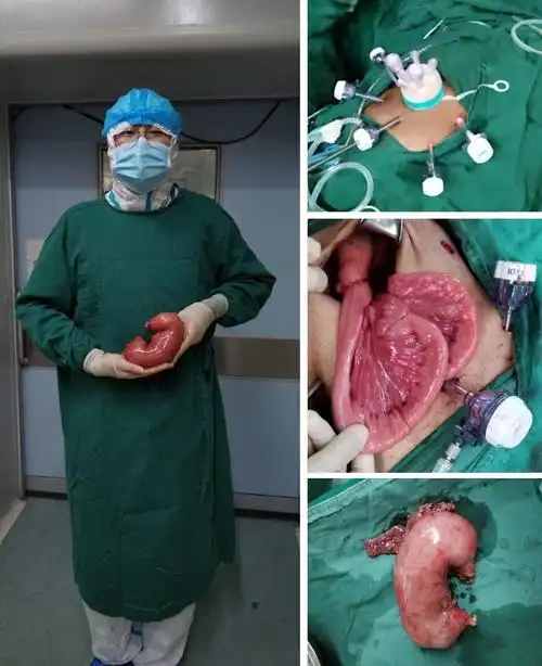 消化道肿瘤-胃癌-腹腔镜次全切胃癌根治术_胃癌_胃癌治疗方式 - 好