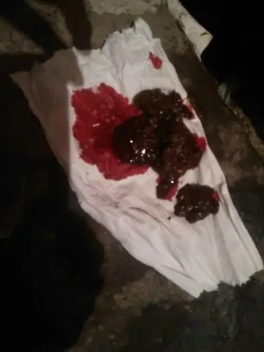 半年多了,大便一直有血,以前不厉害,但是腹痛,过一段时间出血就厉害