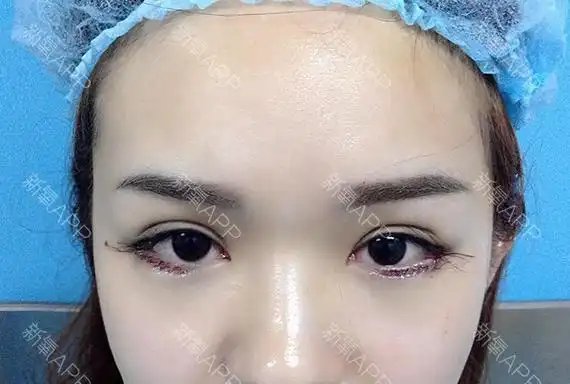 刚做完术后即刻,做眼睑下至要根据自身的眼部基础情况_圈子-新氧美容