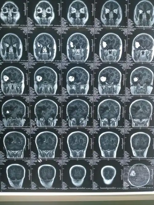 右侧蝶骨嵴脑膜瘤