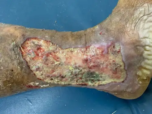 下肢溃疡病例分享