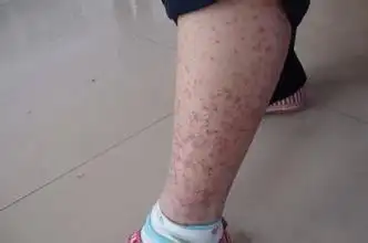 血栓性静脉血管炎治疗