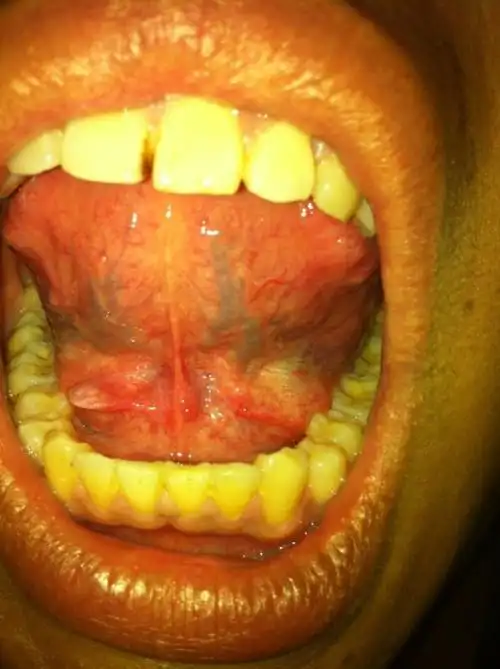 舌头底下长了个白色的包.