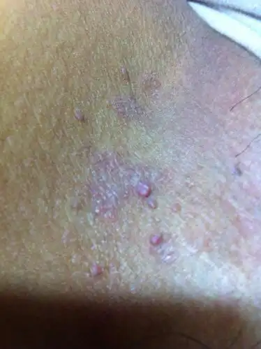 前段时间阴囊上的毛孔长了一个肉痘痘,我把