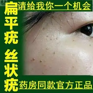 面部专用药膏去除跖疣丝状寻常疣瘊子去疣灵克疣液神器19人付款156