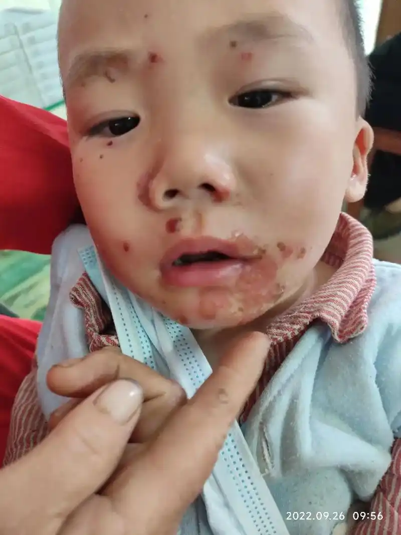 脓疱疮俗称"黄水疮",又名"传染性脓疱病",是一种急 - 抖音