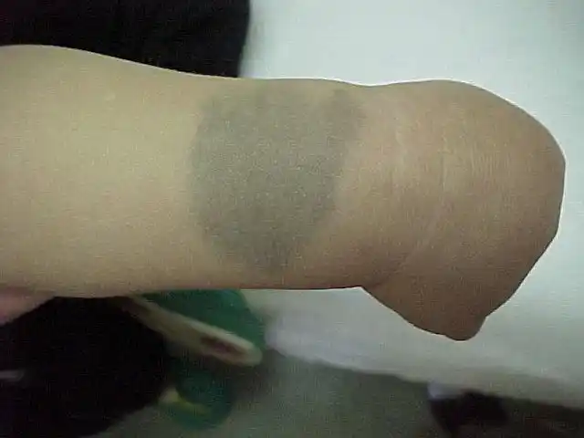 宝宝出生身上为什么会有青斑?