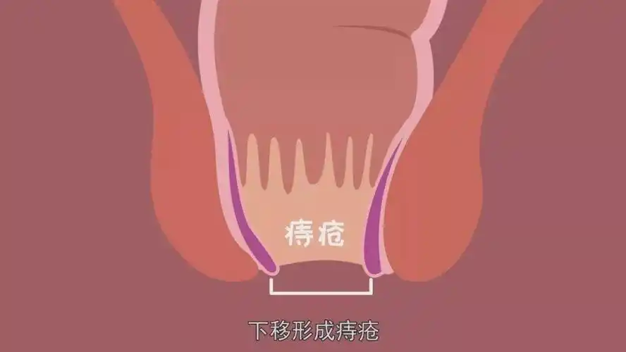 痔疮(hemorrhoids),或者称痔,是临床上一种最常见的肛门疾病,常言道,"