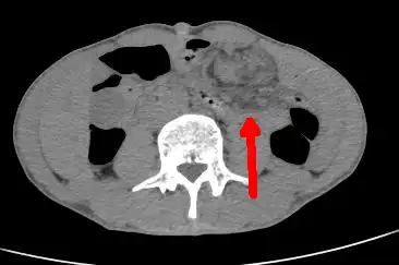 小肠扭转病情突变 及时复位笑容再现