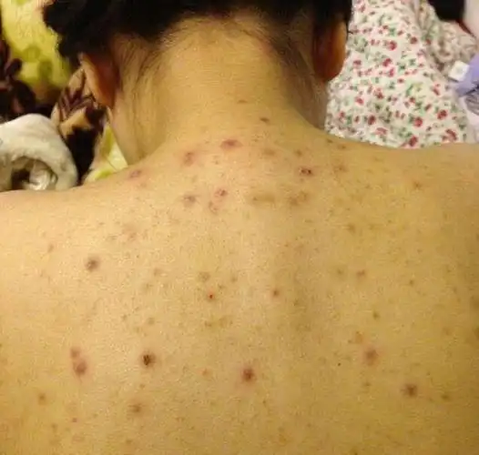 在后背一直能扣出米粒说明后背螨虫上亿坚持3招能除螨