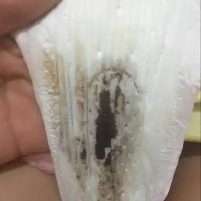 试管移植第八天,突然有出血的迹象,由鲜红血变褐色血,是什麼原因?