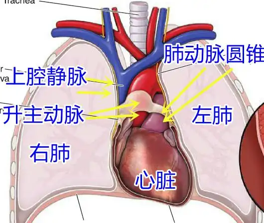 手术前画图研究一个化疗后的巨大纵隔肿瘤