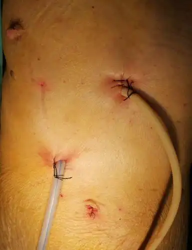 年龄从来都不是问题……89岁胆总管结石微创1小时顺利结束!