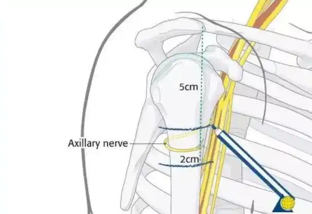 肱骨近端骨折4种入路可选择其中1个没人敢用