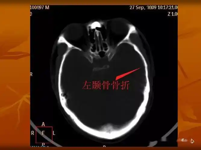 颅骨外伤性骨折ct诊断