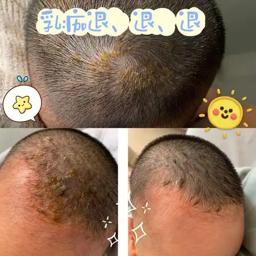 科学去除头垢乳痂奶痂脂溢性皮炎