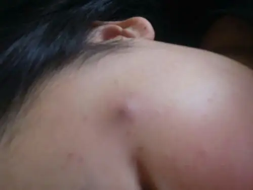 我脸上长个个黑头 一开始没在意 不是很肿 挤了挤