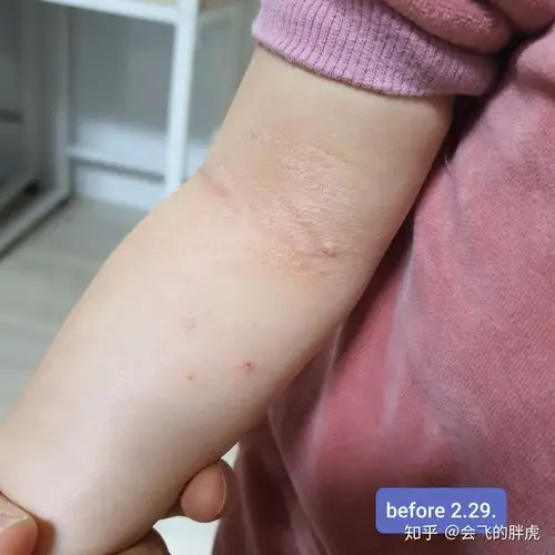 我们家孩子的传染性软疣记录