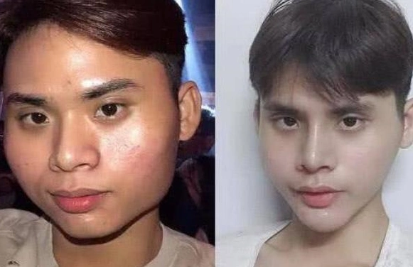 越南nguyen整容变帅哥 吃1月流食称效果非常满意