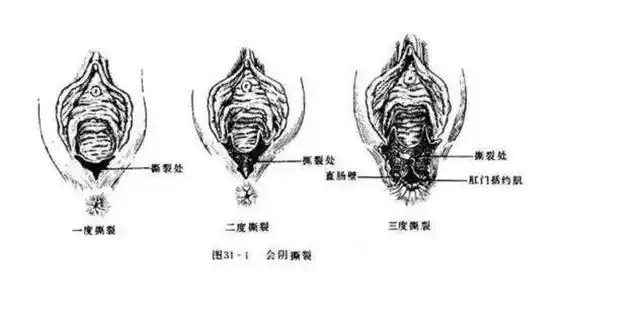 顺产的"侧切"或"撕裂",对以后有什么影响?医生说的实情是?