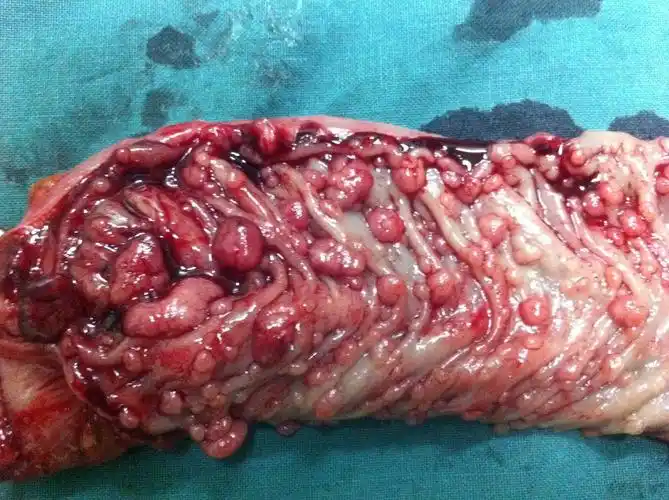 400余枚息肉藏肠内 中年女子腹痛10年 - 好大夫在线