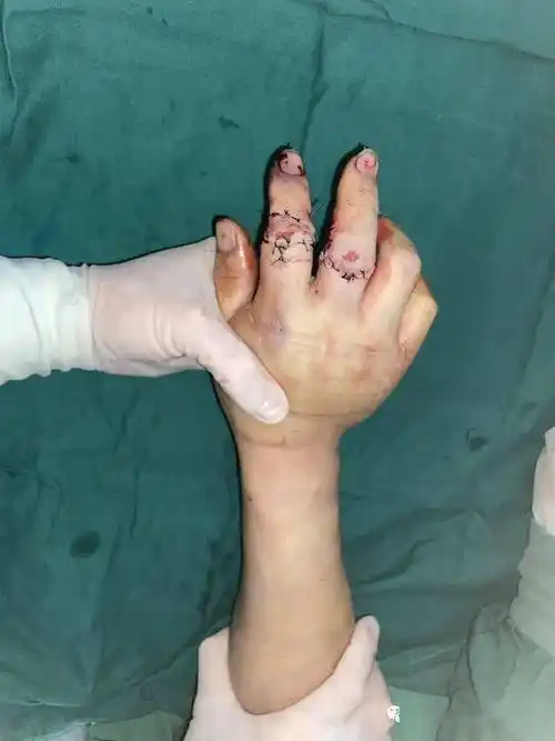 两指旋转撕脱离断,7小时后顺利接活!_手术_患者_手指