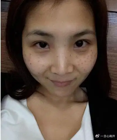 c8激光祛斑效果怎么样想要不留疤术后要注意了