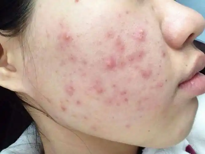 青春痘症状示意图