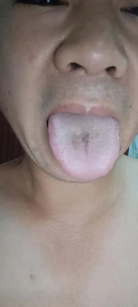 自从阳了过后,每次感冒舌苔都会变黑,有跟我一样的朋友没有