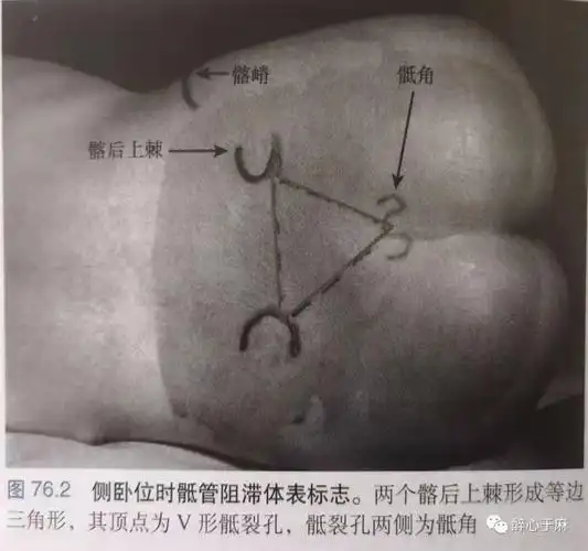 小儿骶管阻滞|裂孔|硬膜外|阻滞|技术|小儿|-健康界