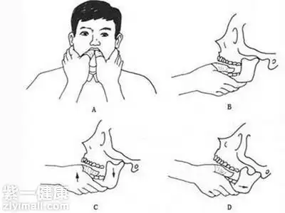 下巴脱臼复位法图解 四步即可帮你完成复位